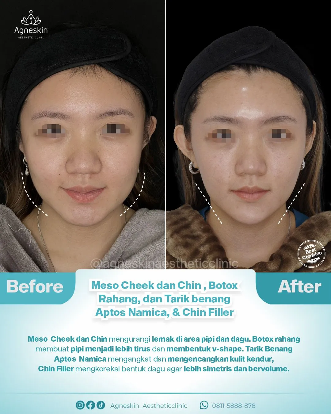 Before After Nose Thread